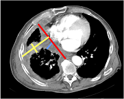 Uni-/Bi-dimensional measurement of mesothelioma